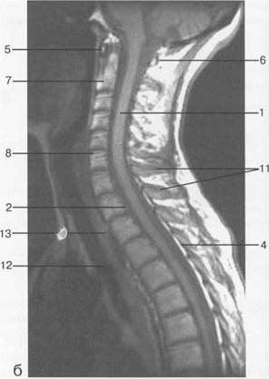 лучевая анатомия позвоночника и спинного мозга - student2.ru