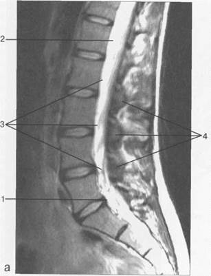 лучевая анатомия позвоночника и спинного мозга - student2.ru