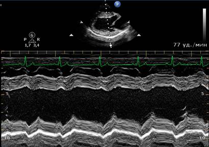 М-модальный режим (одномерная эхокардиография) - student2.ru