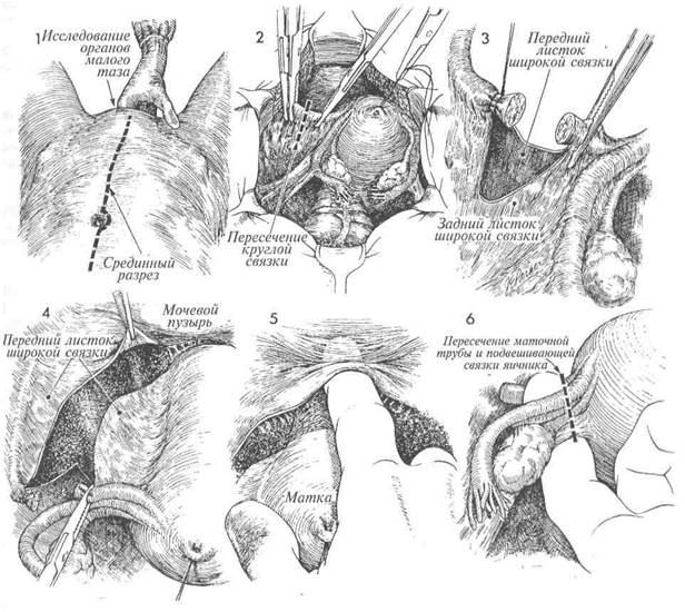 абдоминальная гистерэктомия с двусторонним удалением и без удаления - student2.ru