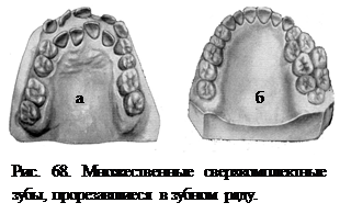 Аномалии количества зубов - student2.ru