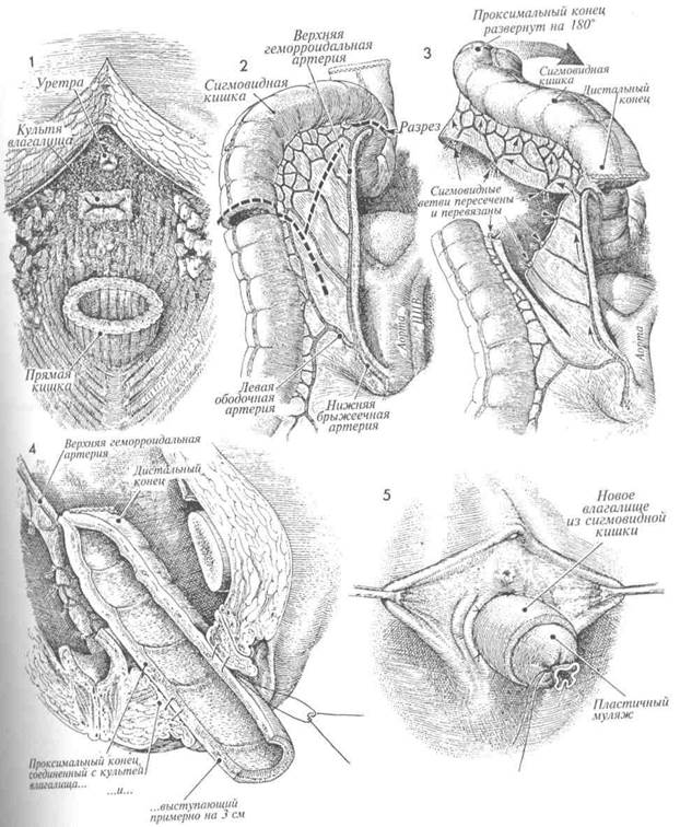 формирование искусственного влагалища из сигмовидной кишки - student2.ru