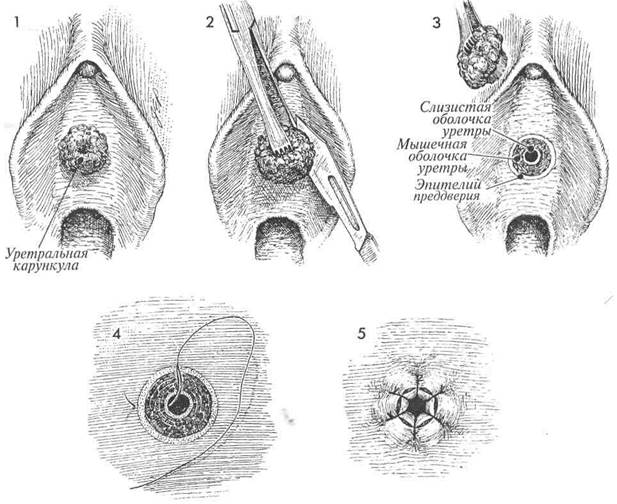иссечение уретральной карункулы - student2.ru