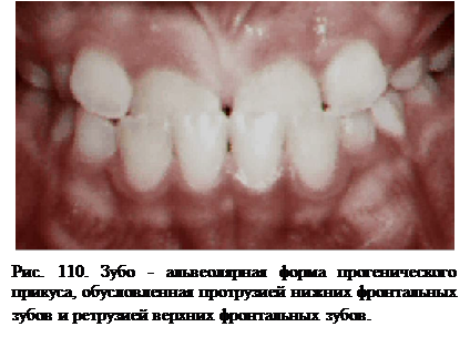 Классификации прогенического прикуса - student2.ru