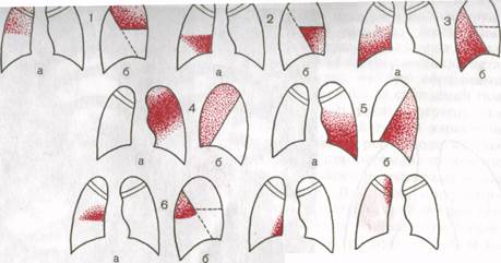 Лучевые симптомы поражений легких - student2.ru