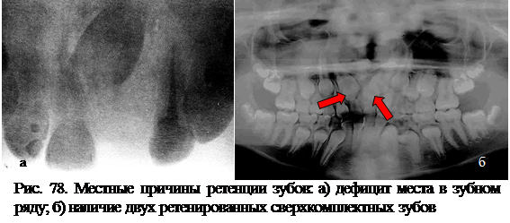 Нарушение прорезывания зубов - student2.ru