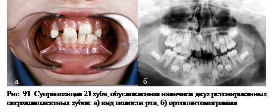 Нарушение прорезывания зубов - student2.ru