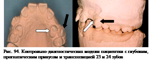 Нарушение прорезывания зубов - student2.ru