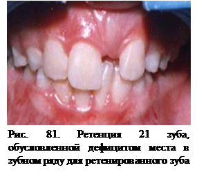 Нарушение прорезывания зубов - student2.ru