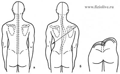 Определение искривления позвоночника - student2.ru