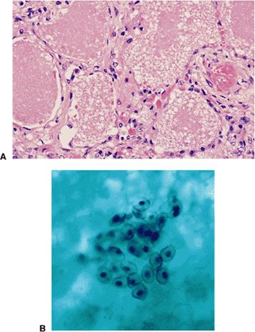 Pneumocystis jiroveci - student2.ru