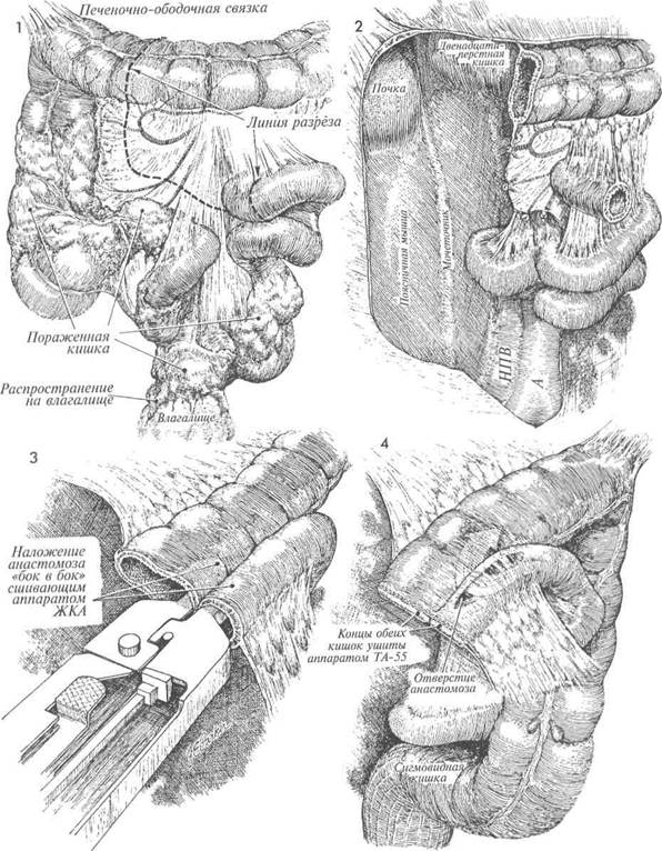 правосторонняя гемиколэктомия с формированием илеотрансверзоанастомоза - student2.ru