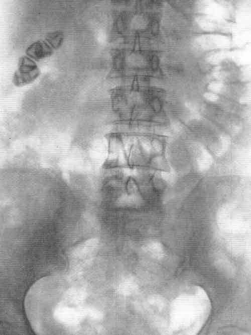 ретроградная (восходящая) пиелоуретерография - student2.ru
