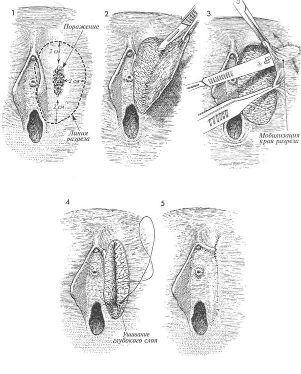 широкое локальное иссечение вульвы с первичным закрытием дефекта z-образным - student2.ru