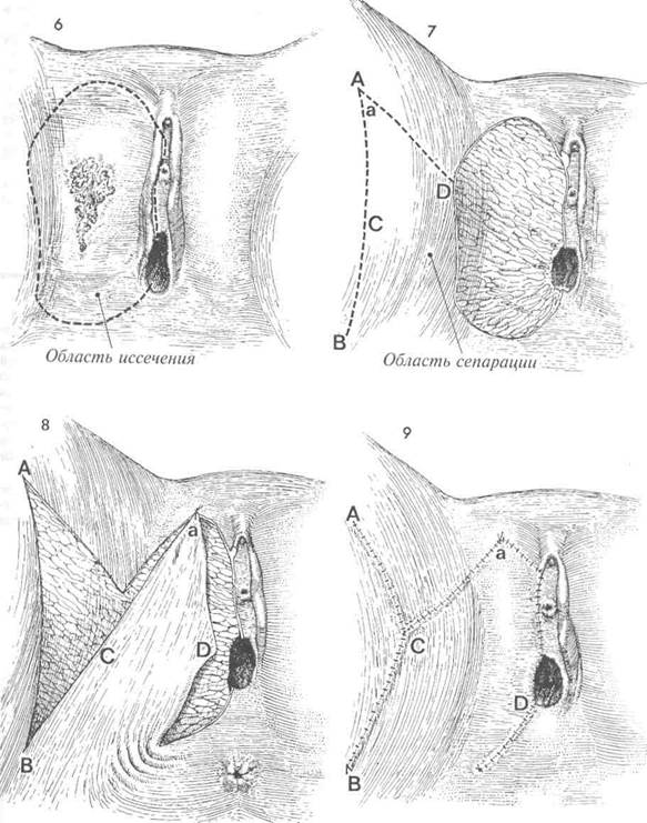широкое локальное иссечение вульвы с первичным закрытием дефекта z-образным - student2.ru