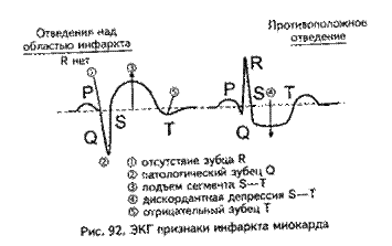 Трепетание и фибрилляция желудочков. - student2.ru