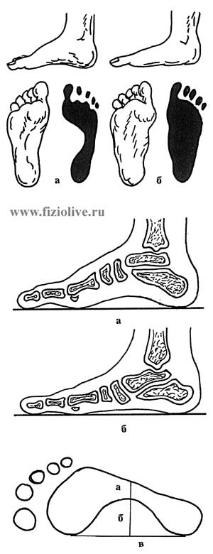 Внешний вид стоп и их отпечатков - student2.ru