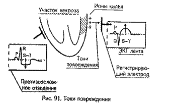 Электрокардиографические признаки инфаркта миокарда - student2.ru