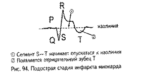Электрокардиографические признаки инфаркта миокарда - student2.ru