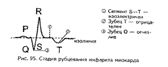 Электрокардиографические признаки инфаркта миокарда - student2.ru