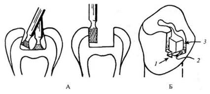 этапы препарирования кариозной полости - student2.ru