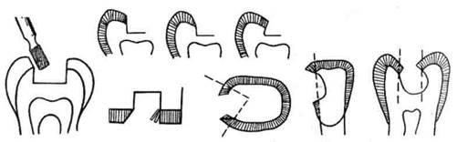 этапы препарирования кариозной полости - student2.ru