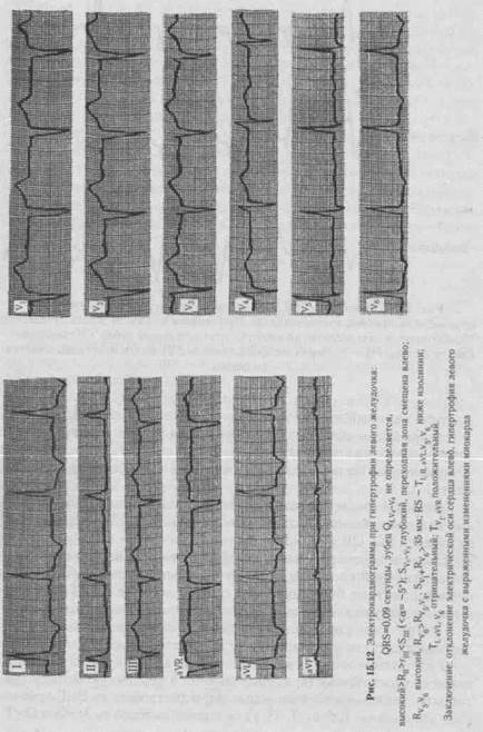 Зубцы и интервалы электрокардиограммы (ЭКГ) - student2.ru