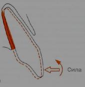 Оптимальные силы для ортодонтического зубного перемещения - student2.ru