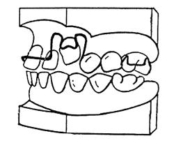 Оптимальные силы для ортодонтического зубного перемещения - student2.ru