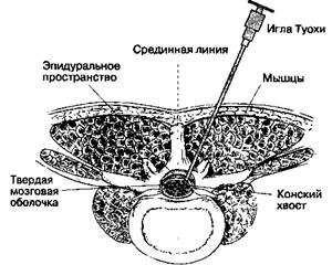 А. Идентификация эпидурального пространства. - student2.ru