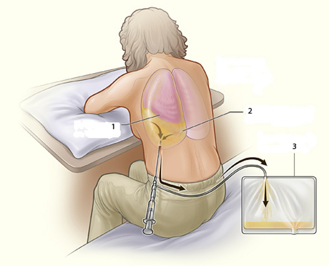 Алгоритм проведения плевральной пункции - student2.ru