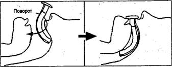 Алгоритм введения ротоглоточного воздуховода - student2.ru
