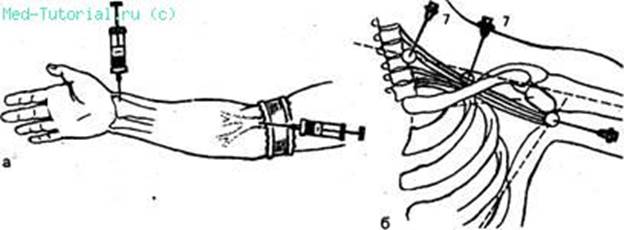 Анестезия Плечевого сплетения по Куленкампфу - student2.ru