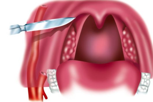 Ангина глоточной миндалины (аденоидит) - student2.ru