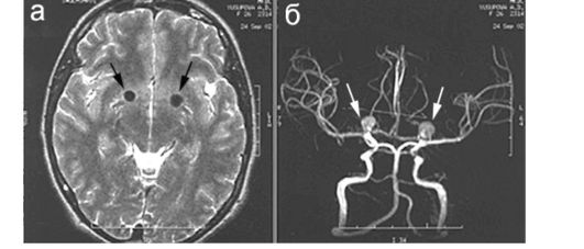 аномалии сосудов головного мозга - student2.ru