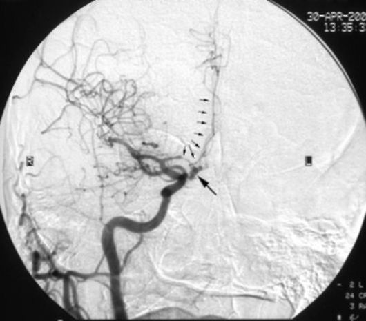 аномалии сосудов головного мозга - student2.ru