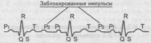 Атриовентрикулярлы блокада.1 дәрежесі - student2.ru