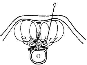 Блокади задніх гілок спинномозкових нервов. - student2.ru