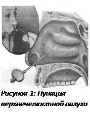 Болезни околоносовых пазух - student2.ru