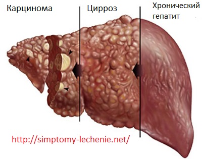 Что происходит после попадания вируса гепатита в организм? - student2.ru