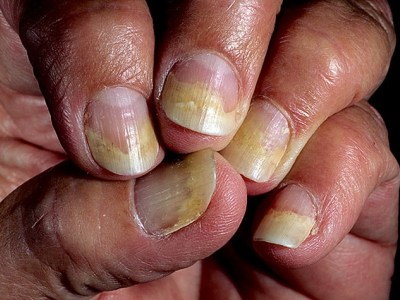 Деформация ногтей из-за травмы - student2.ru