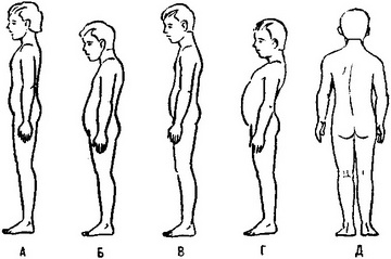 Функциональные нарушения осанки - student2.ru