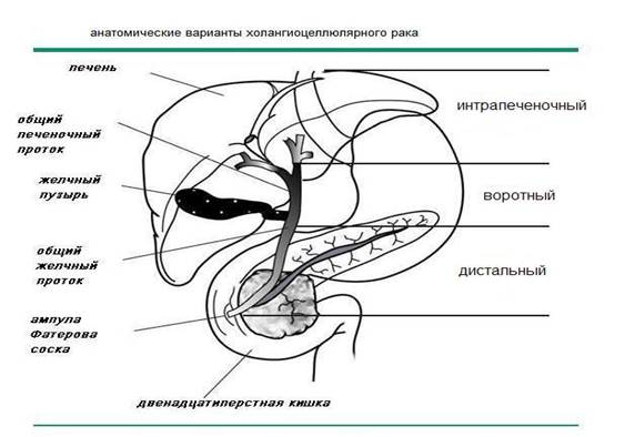 Гистологическая классификация. ХОЛАНГИОЦЕЛЛЮЛЯРНЫЙ РАК (С22.1, С23-С24) - student2.ru