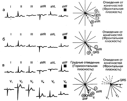 глава 178. электрокардиография - student2.ru