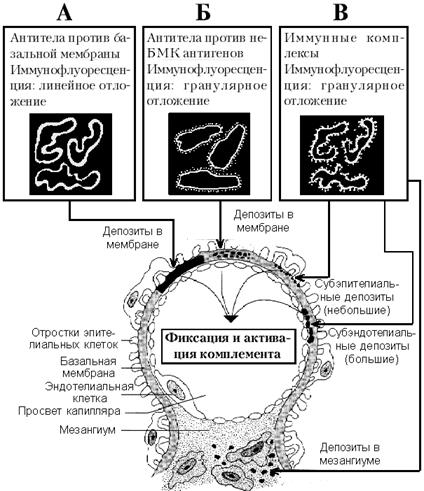 гломерулярные заболевания почек или гломерулопатии - student2.ru