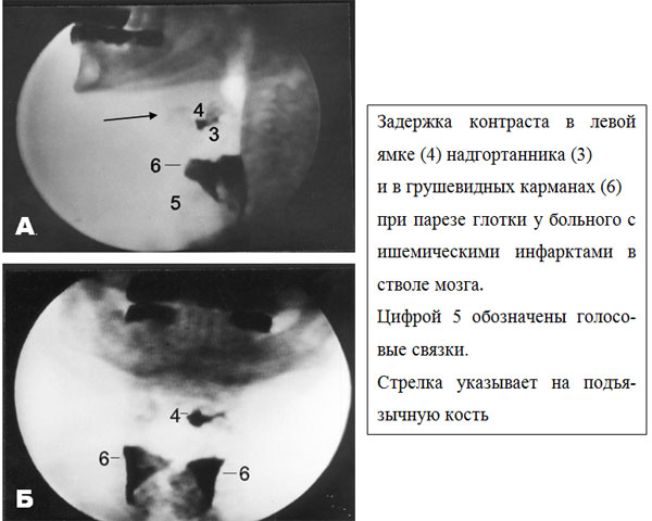 Маразматический («общеатрофический», «кахектический») тип: - student2.ru