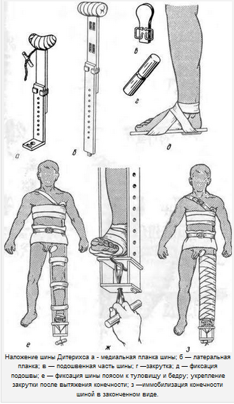 Иммобилизация нижней конечности при переломе бедра. Техника. - student2.ru