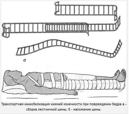 Иммобилизация нижней конечности при переломе бедра. Техника. - student2.ru