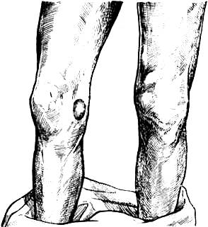 исследование патологически измененного коленного сустава - student2.ru