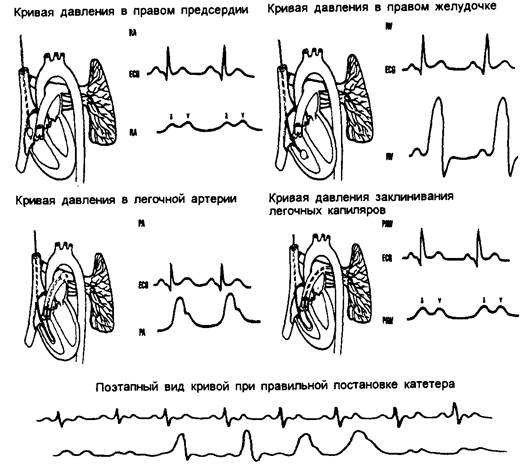 Измерение центрального венозного давления - student2.ru